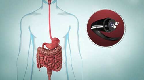 上消化道内镜检查