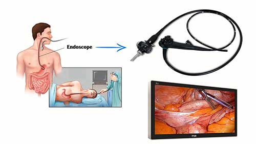 什么是内窥镜检查