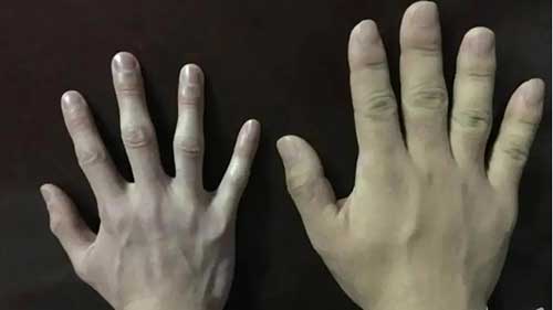 内分泌学讲座：肢端肥大症