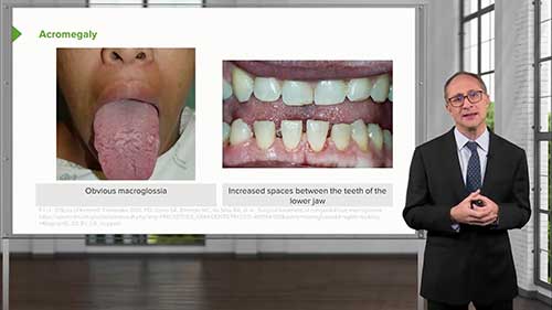 内分泌学讲座：垂体病例