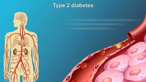 2型糖尿病的治疗与管理