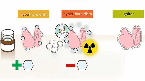 常见的甲状腺问题