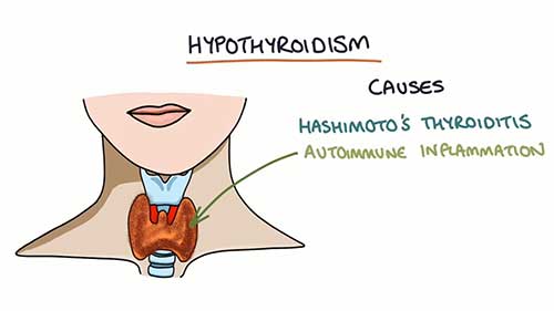 甲状腺功能减退概述