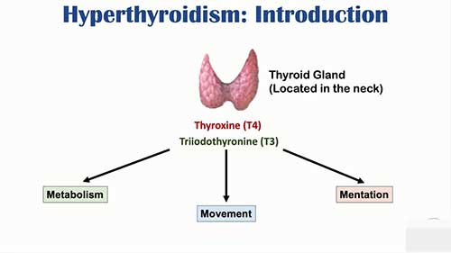 甲状腺机能亢进