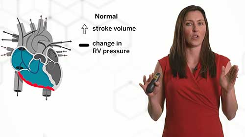 肺动脉高压：右心室功能障碍