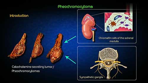 什么是嗜铬细胞瘤
