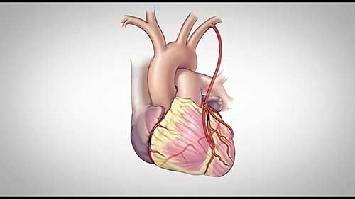 冠状动脉疾病基础知识