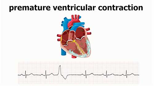 室性早搏动画演示