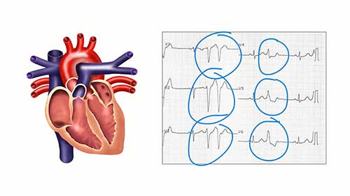 如何判断室性异位搏动