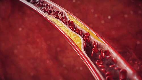 什么是动脉粥样硬化