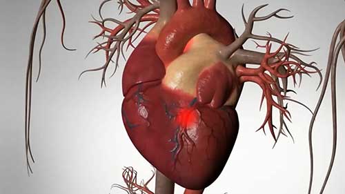 三种心脏病的区别