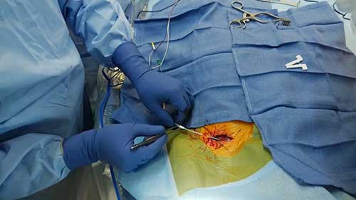 植入式心律转复除颤器手术演示