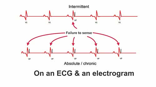 起搏器常见问题：感知不良