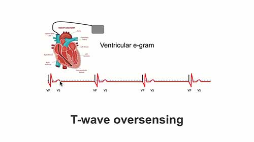 起搏器常见问题：感知过度