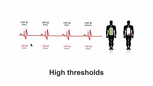 起搏器常见问题：故障排除提示