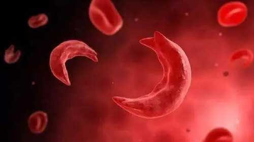 什么是镰状细胞性贫血