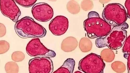 什么是再生障碍性贫血