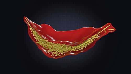 恶性镰状细胞突变的科学
