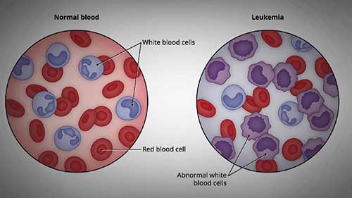 全面解析白血病