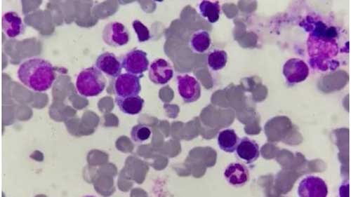 血栓性血小板减少性紫癜