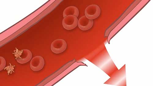 血友病患者如何止血