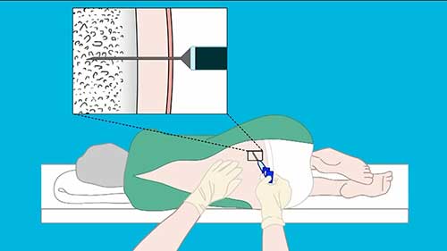 如何进行骨髓检查