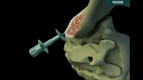 骨髓穿刺和骨髓活检操作演示
