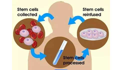 什么是自体干细胞移植