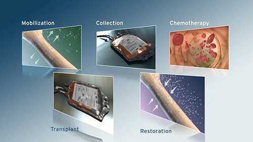 外周血造血干细胞移植全过程