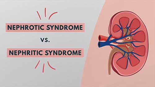 肾病综合征与肾炎综合征