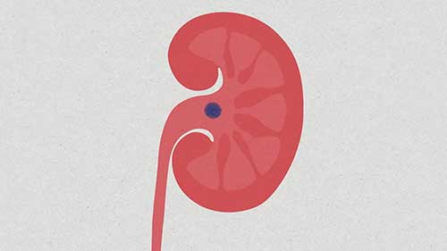 肾结石是怎么形成的