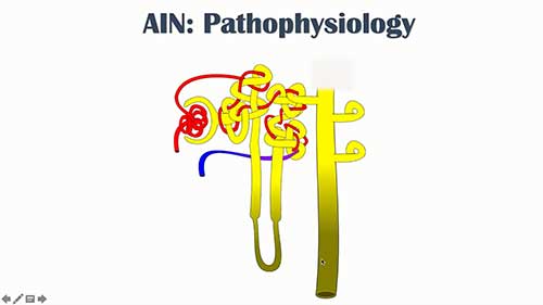 急性间质性肾炎概览