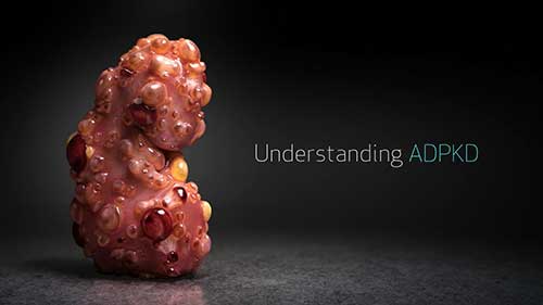 常染色体显性多囊肾的发病机制