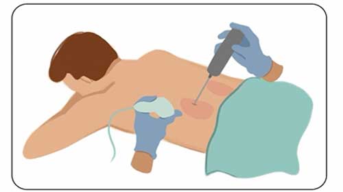 肾活检的具体流程