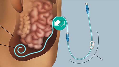 家庭腹膜透析的适应人群