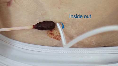 腹膜透析导管出口处换药