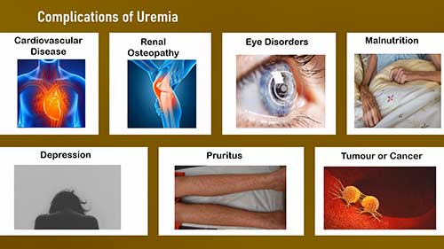 尿毒症基础知识