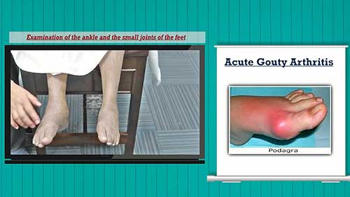 风湿病检查：踝足关节