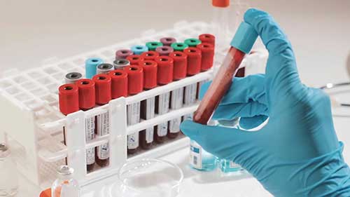 什么是类风湿因子测试