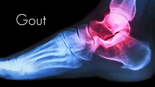 痛风：发作因素