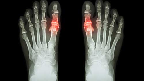 痛风：疾病发展