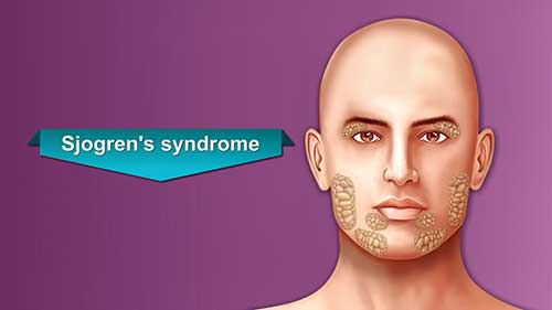 什么是干燥综合征