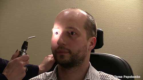 相对性传入性瞳孔障碍