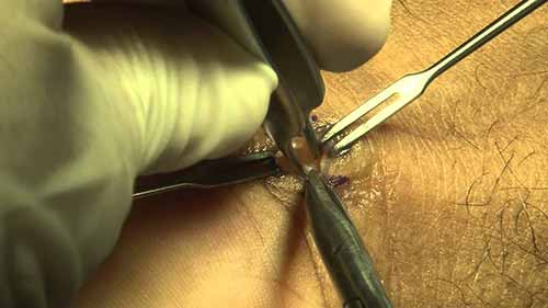 腕管综合症手术