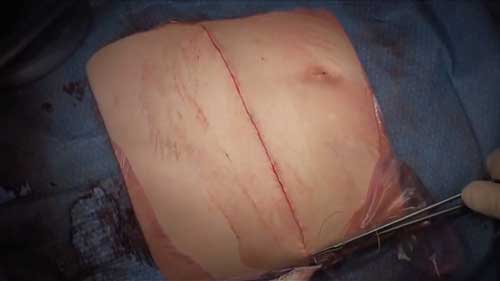 肾母细胞瘤移除手术