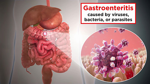 食物大肠杆菌中毒