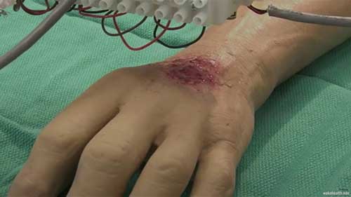 3D生物打印人体皮肤