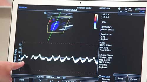 多普勒超声仪的临床应用