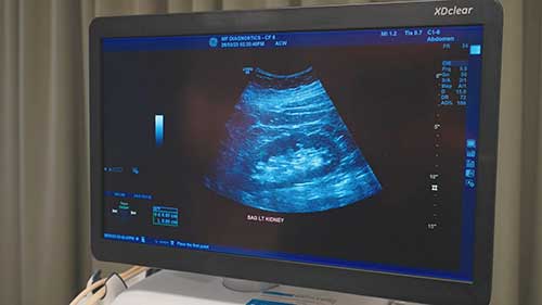 腹部超声检查