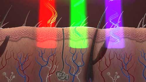 美国激光治疗仪